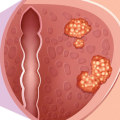 The Impact of Prostate Cancer: An Expert's Perspective
