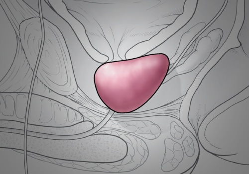 Managing the Last Stages of Prostate Cancer